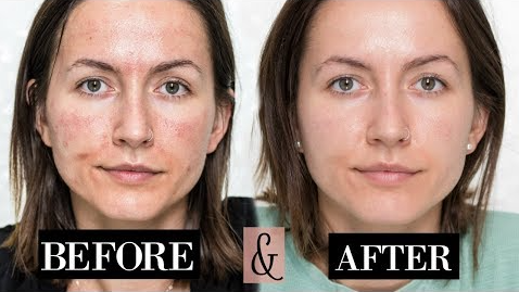 What to Apply on Face After Microneedling