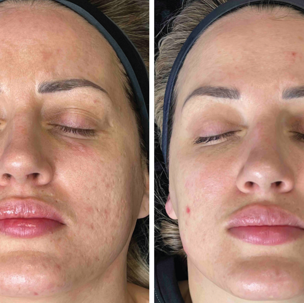 What to Apply on Face After Microneedling