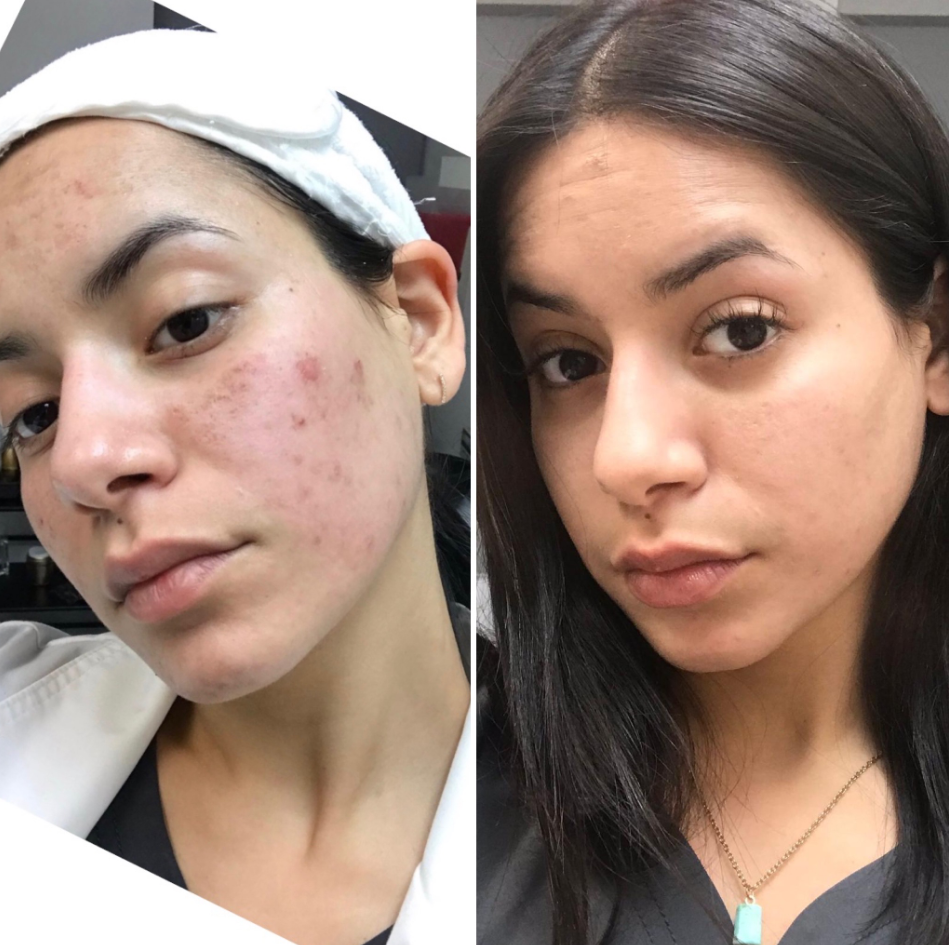What to Apply on Face After Microneedling