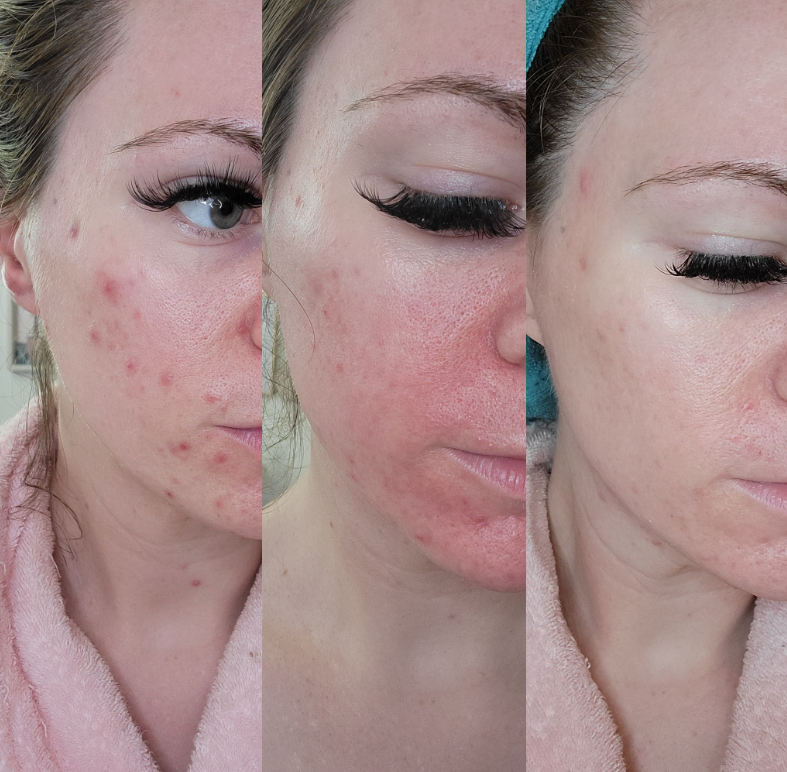 What to Apply on Face After Microneedling