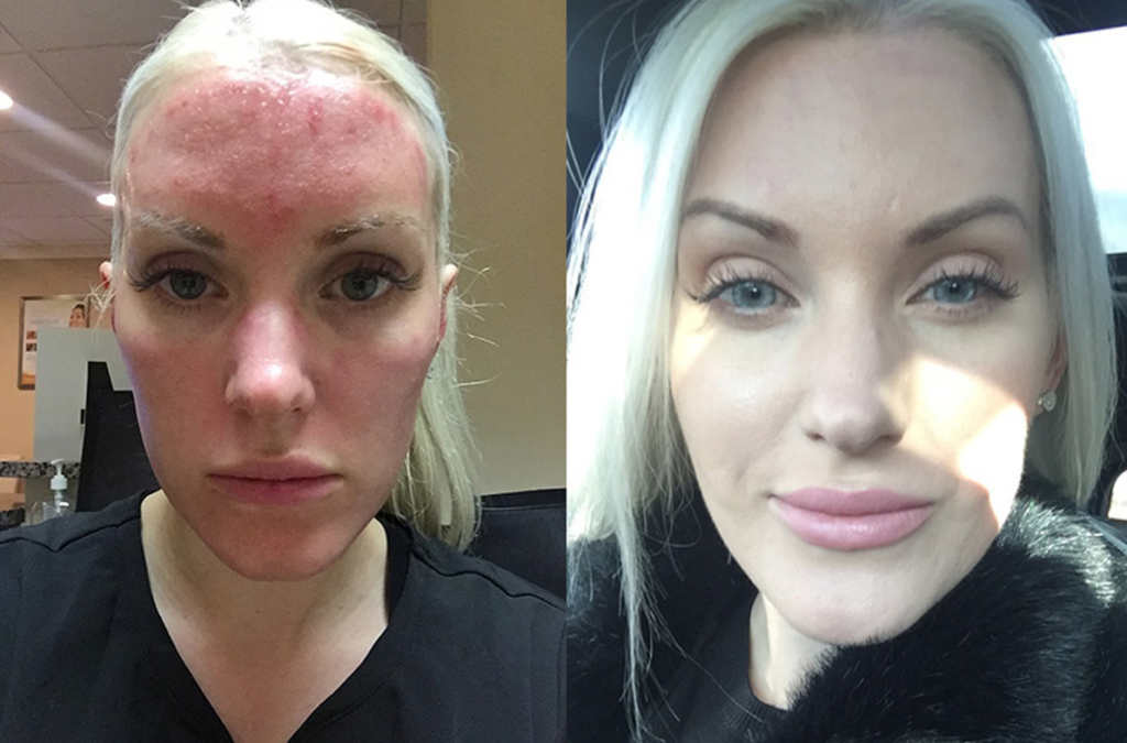 What to Apply on Face After Microneedling