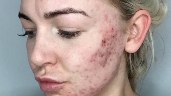 Is it safe to use dettol on face