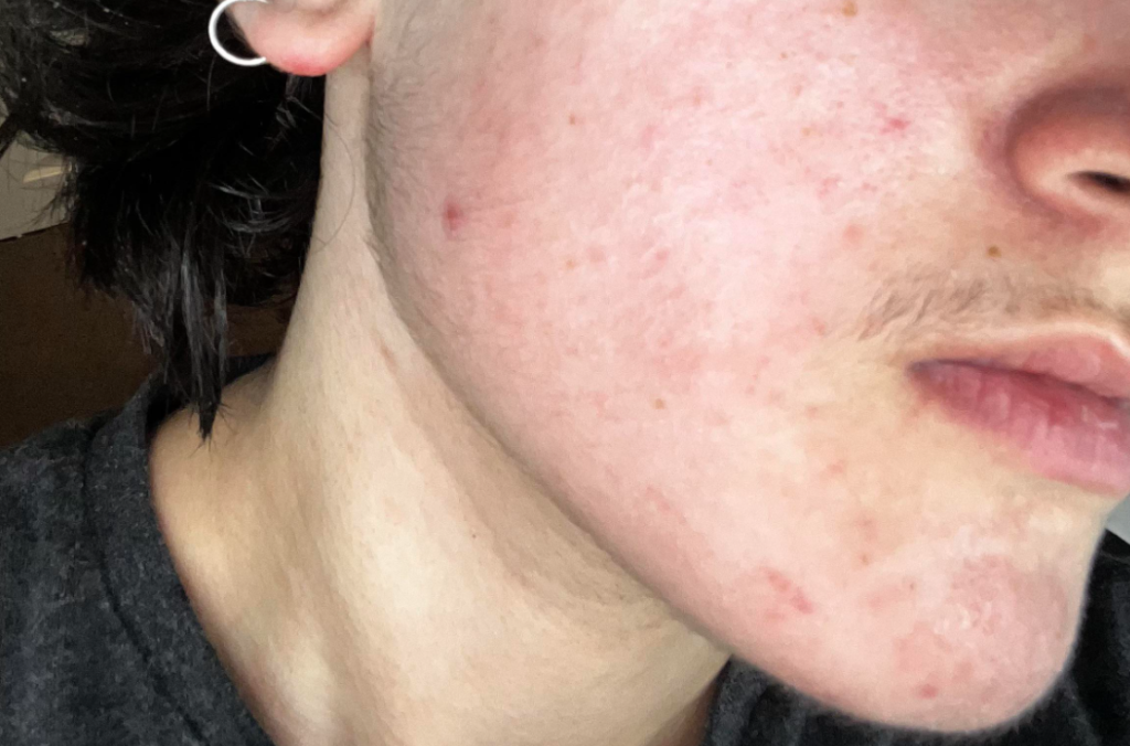 Is it safe to use dettol on face