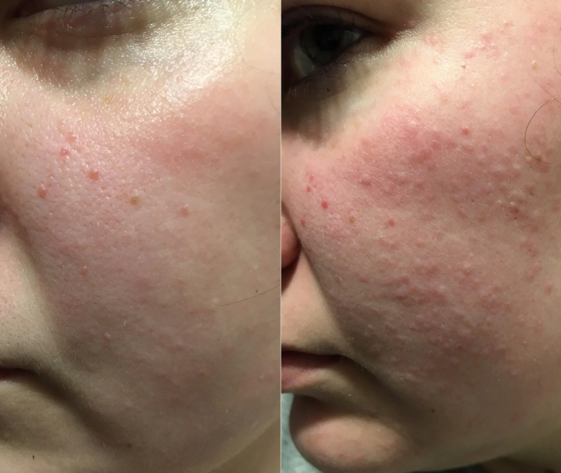 Is it safe to use dettol on face