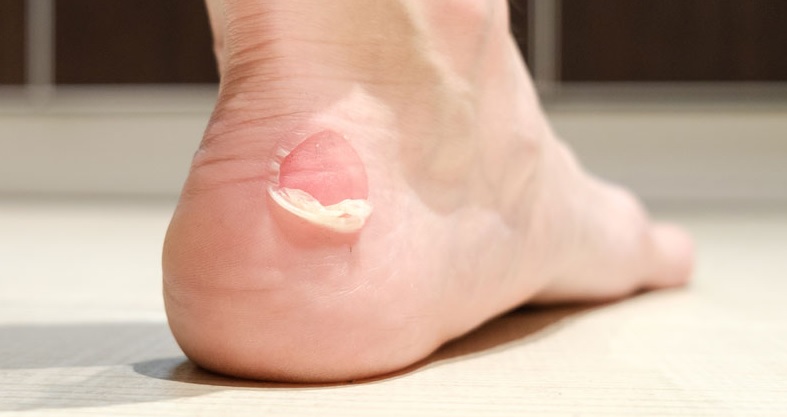 Why shoes cause blisters ?